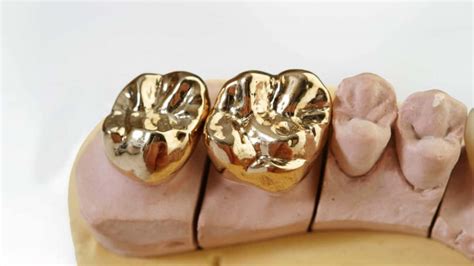 Altın diş nasıl yapılır